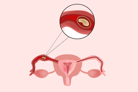 Menstruation and ectopic pregnancy