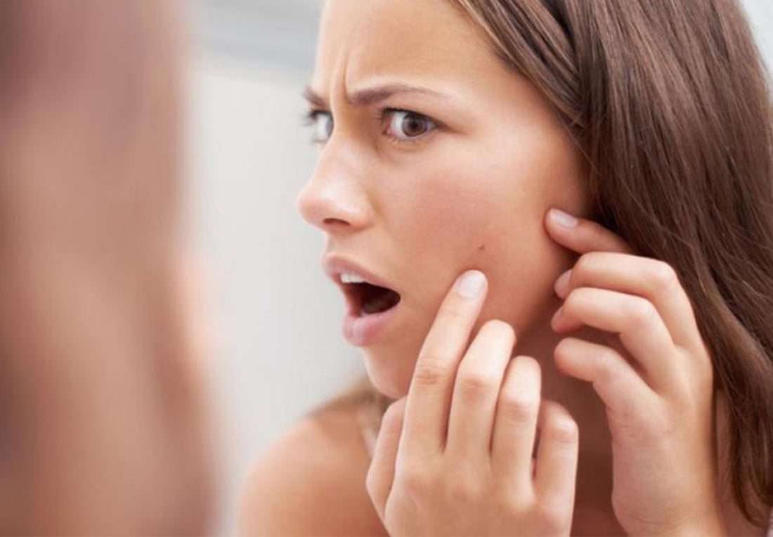 pimples-during-menstruation